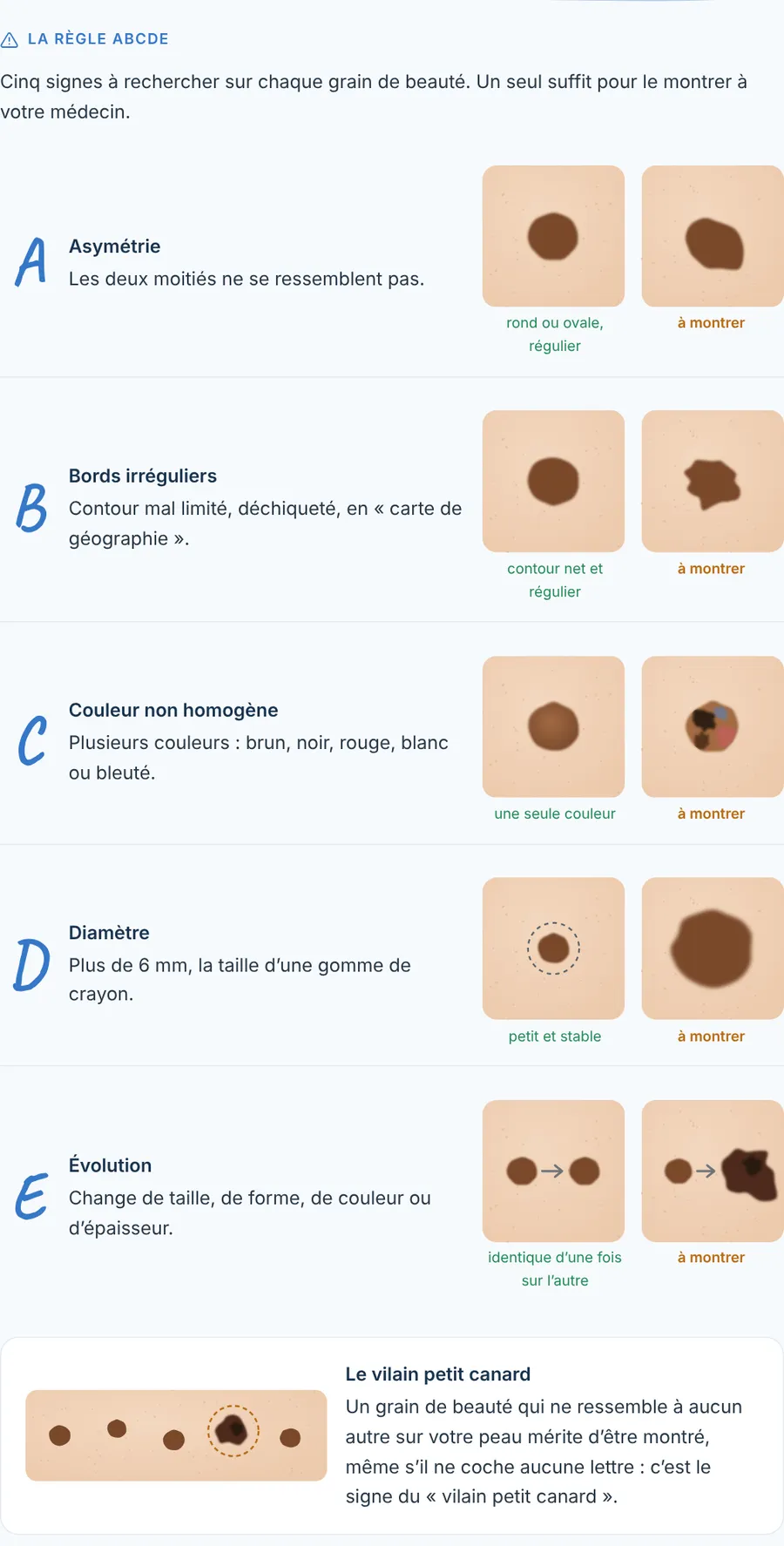 La règle ABCDE — pour chaque lettre, un grain de beauté rassurant et un à montrer (dessins)